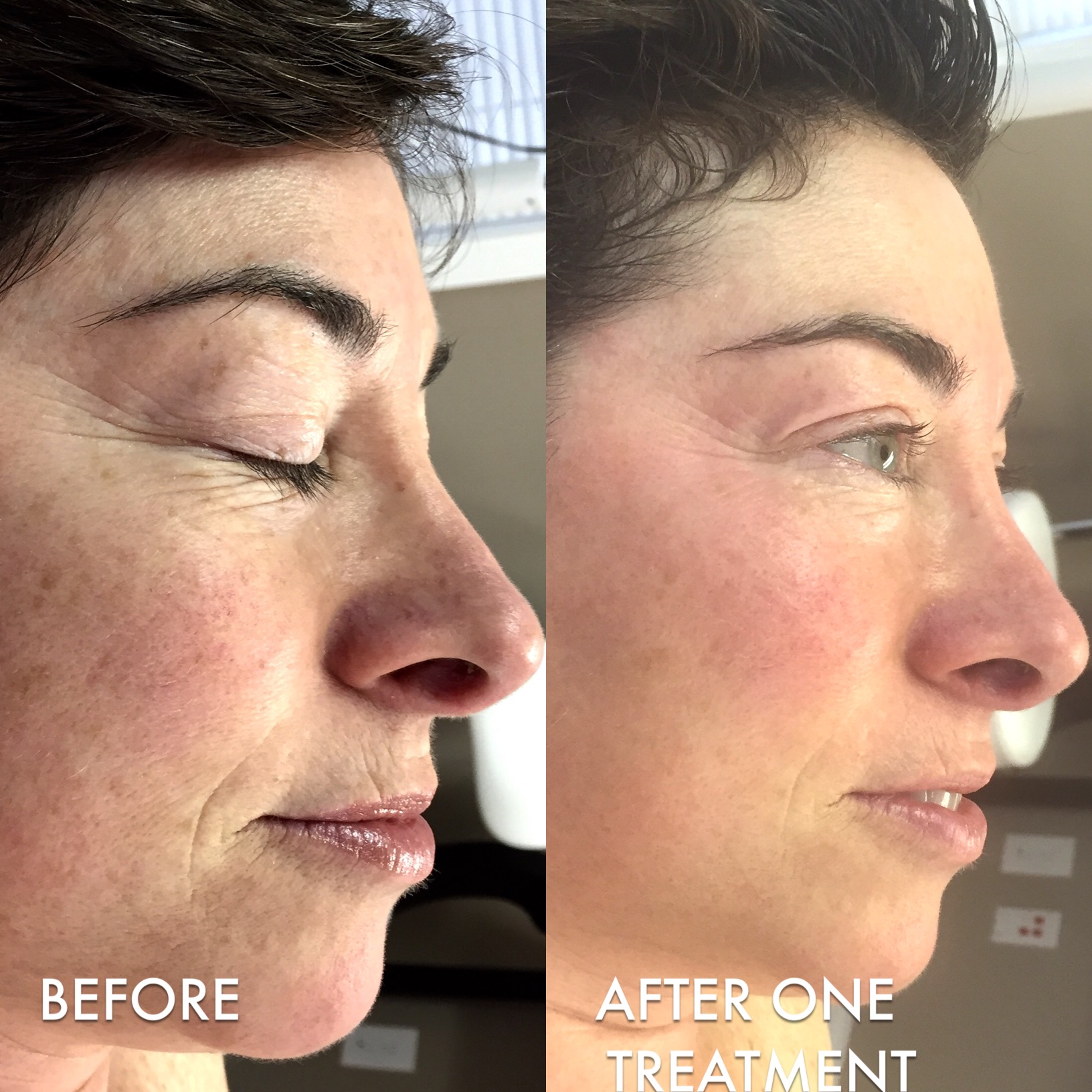 before and after skin treatment side views of a woman's face